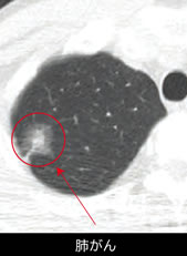 肺がん健診